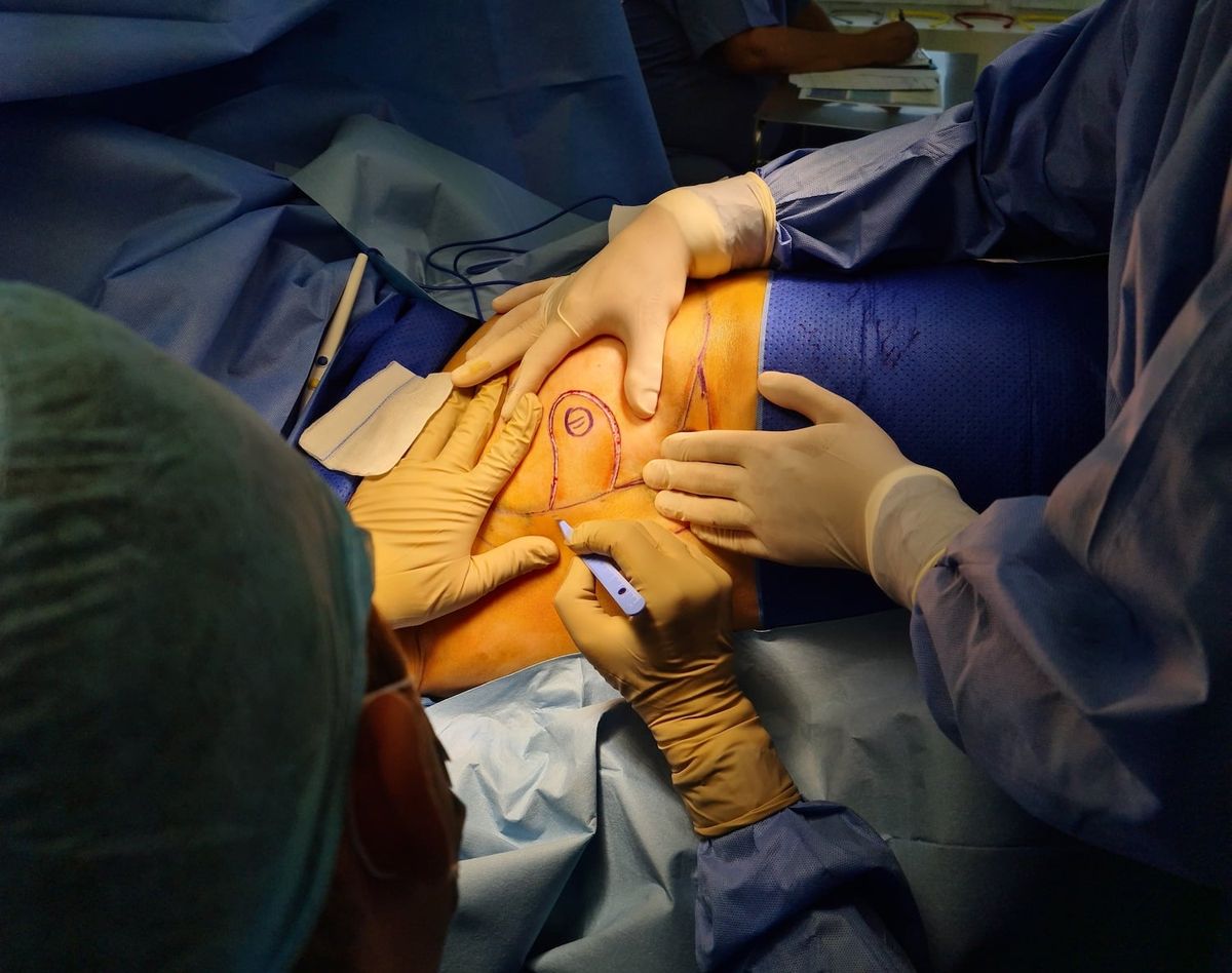 W rabczańskim szpitalu – mastektomia i rekonstrukcja jednocześnie